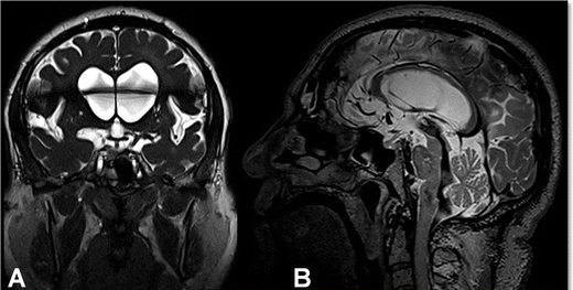 Adult hydrocephalus MRI example.