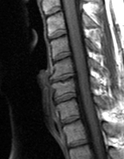 Sagittal cervical spine MRI example.
