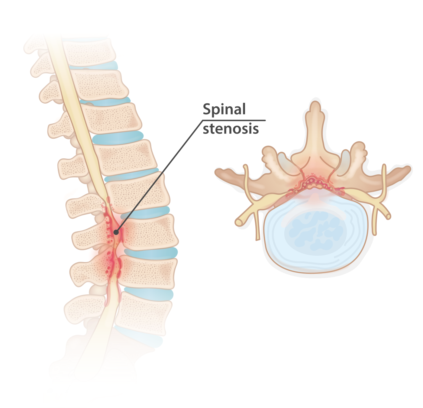 Lumbar spinal stenosis anatomy illustration.