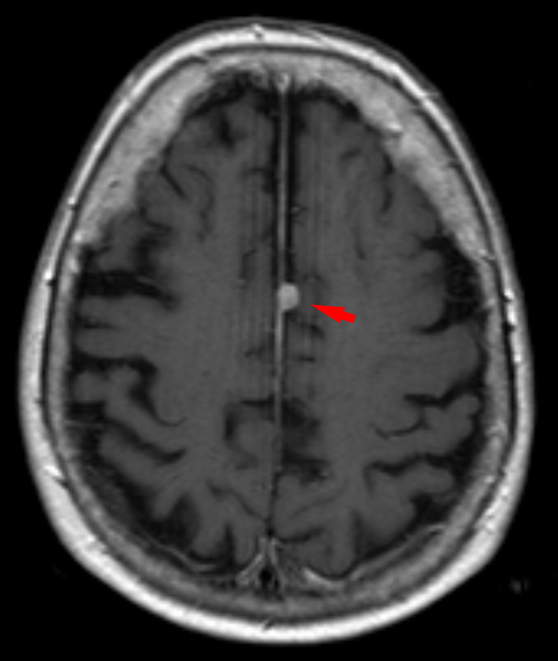 Axial MRI example of a falx meningioma.